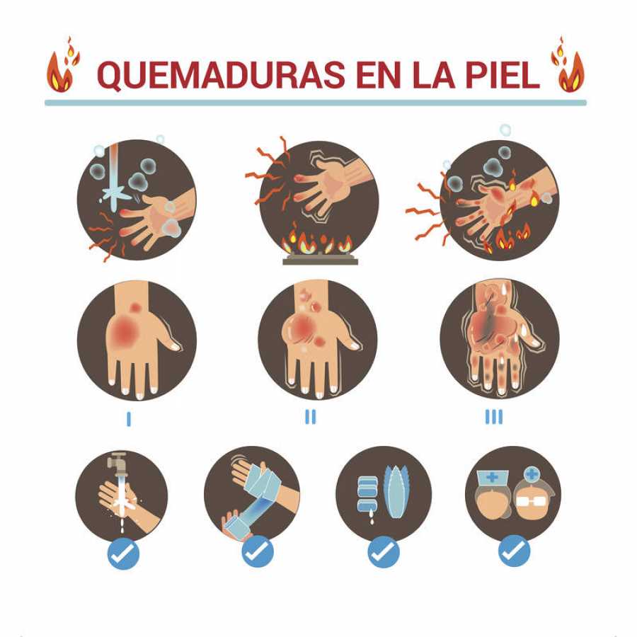 ¿QUÉ HACER ANTE UNA QUEMADURA?