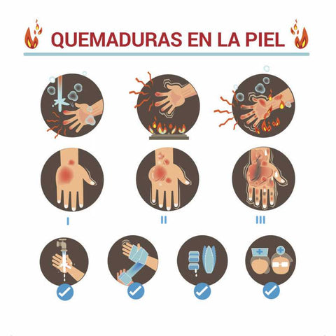 ¿QUÉ HACER ANTE UNA QUEMADURA?